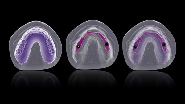 Excellence in Implant-Supported Overdentures - Image 10