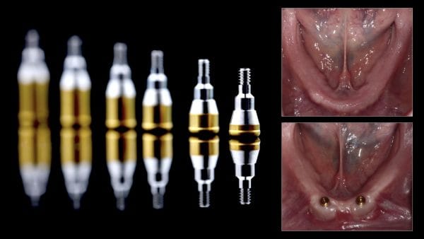 Excellence in Implant-Supported Overdentures - Image 7