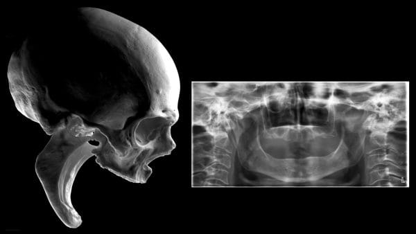 Excellence in Implant-Supported Overdentures - Image 6