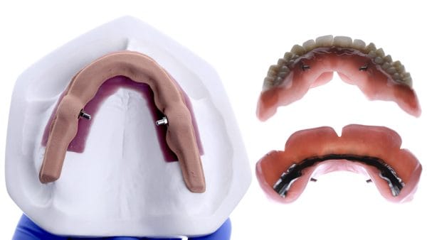 Excellence in Implant-Supported Overdentures - Image 5
