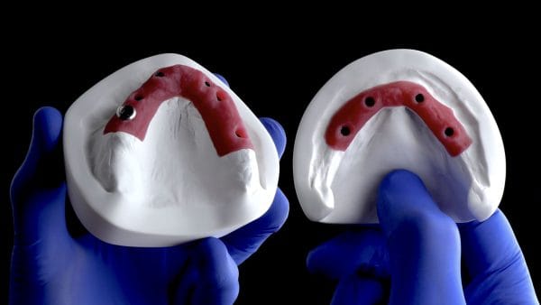 Excellence in Implant-Supported Overdentures - Image 4