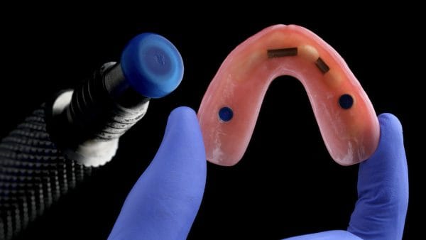 Excellence in Implant-Supported Overdentures - Image 3