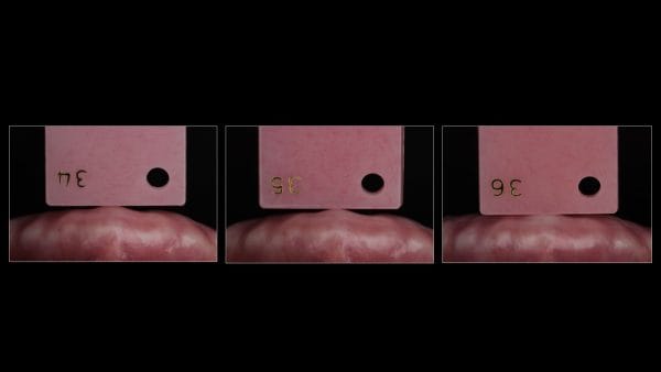 Excellence in Implant-Supported Overdentures - Image 11