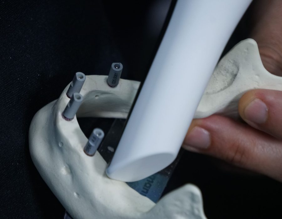 Implant restorative track