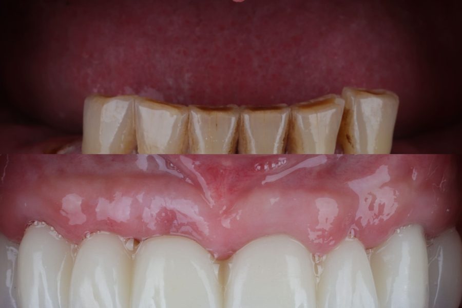 Integration of Digital Workflow in Implant Dentistry2
